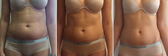 Kryolipolyse & Body Contouring Aschaffenburg